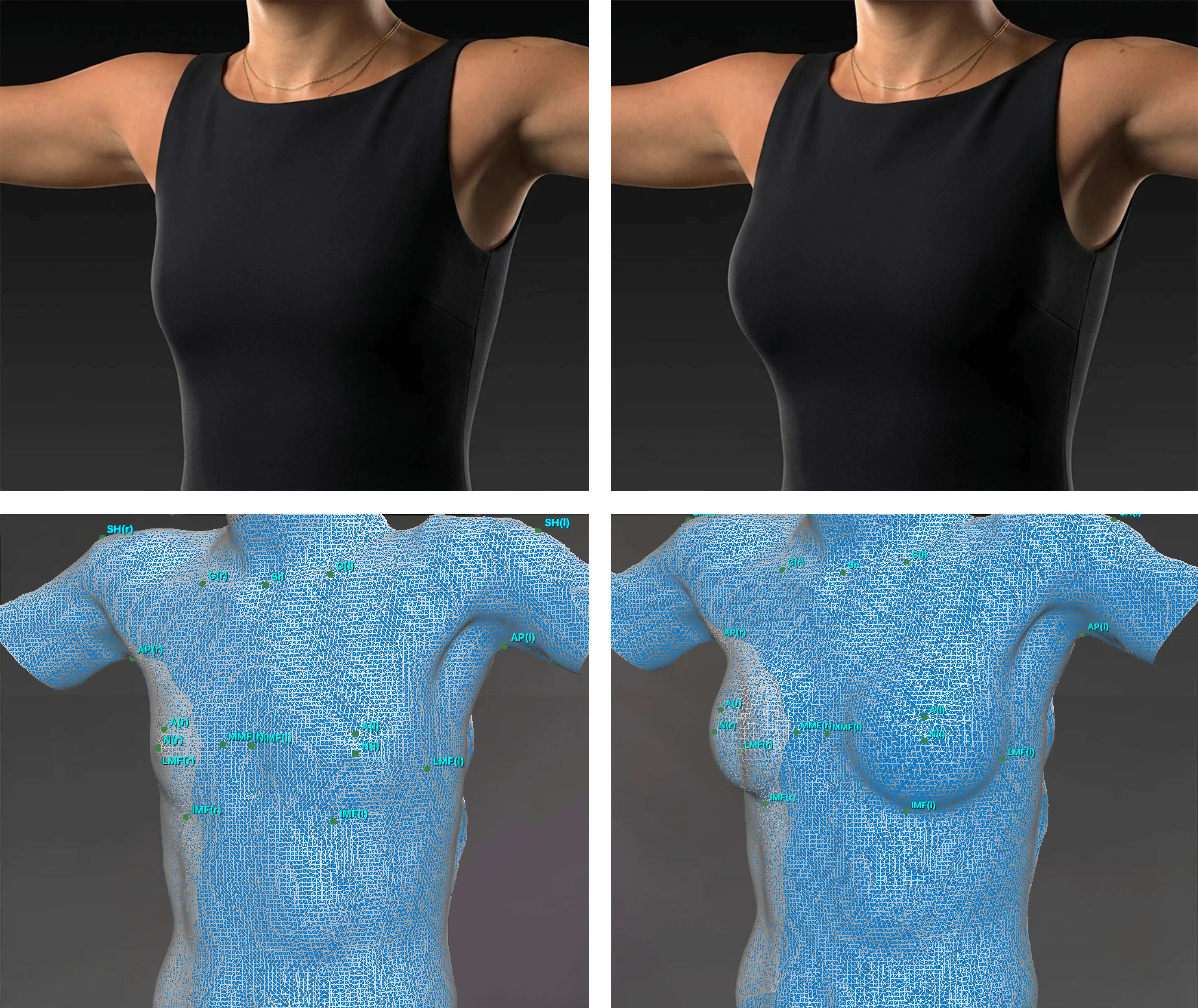 VECTRA 3D simulation of a breast augmentation result.